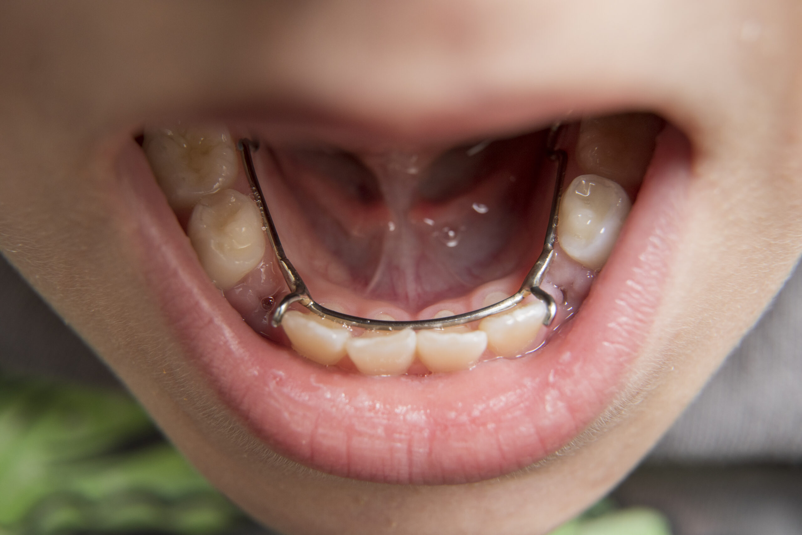 Complex Orthodontics Case with Braces by a Pediatric Dentist.